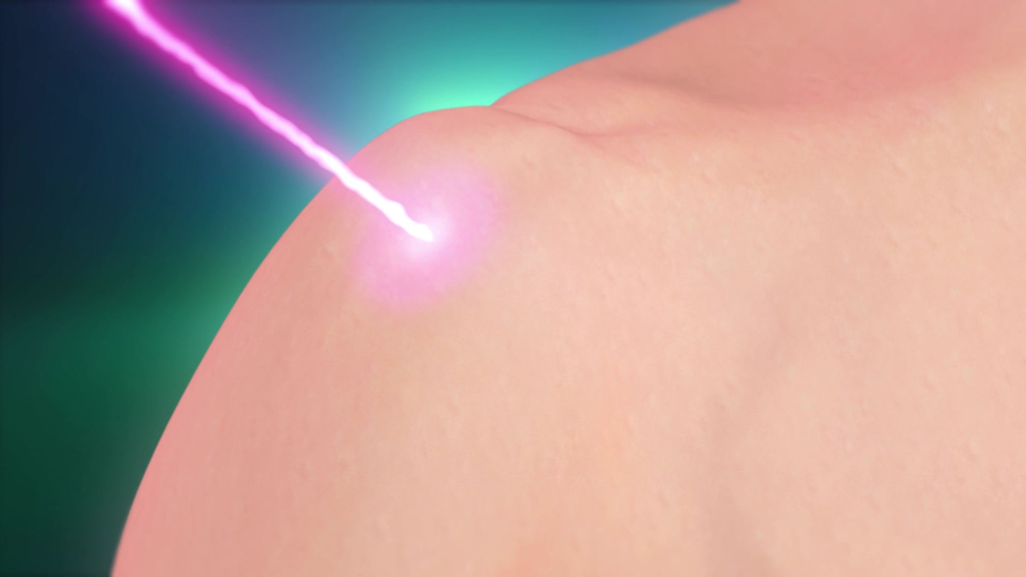 About CureWave Lasers HILT Technology